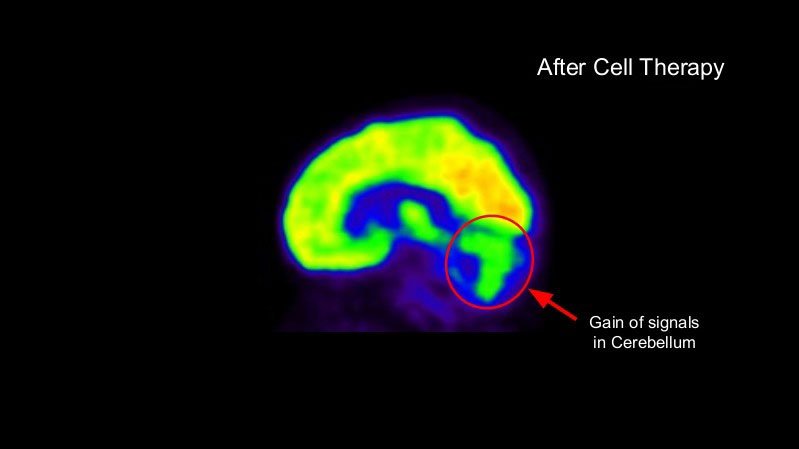 After-cell-therapy-1