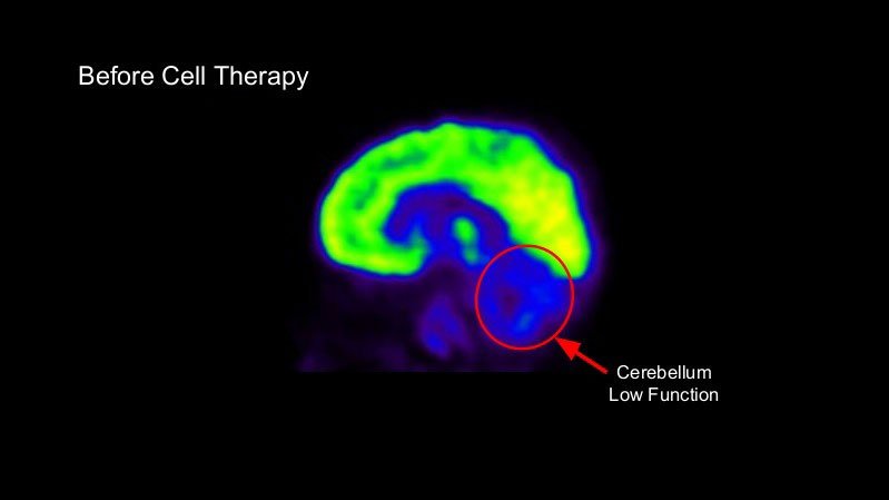 before-cell-therapy-1